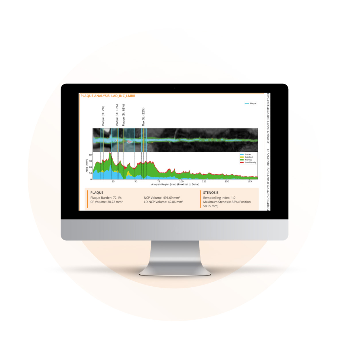 CaRi-Heart Analysis